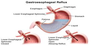 What Is Acid Reflux