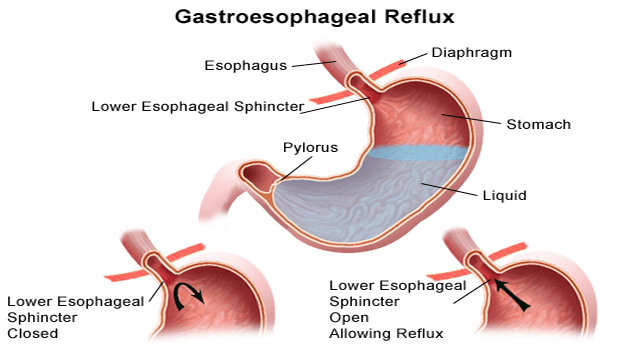 What Is Acid Reflux